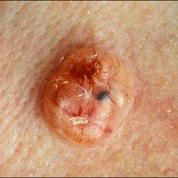 Example of skinCancer